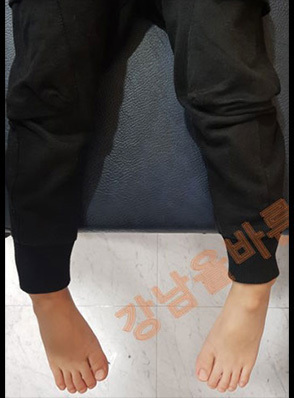 안짱다리(안짱걸음) 교정 전·후	
