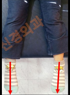 안짱다리(안짱걸음) 교정 전·후
